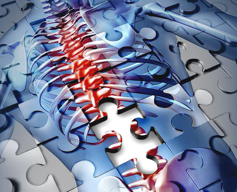 L'ostéoporose et l'augmentation du nombre de fractures