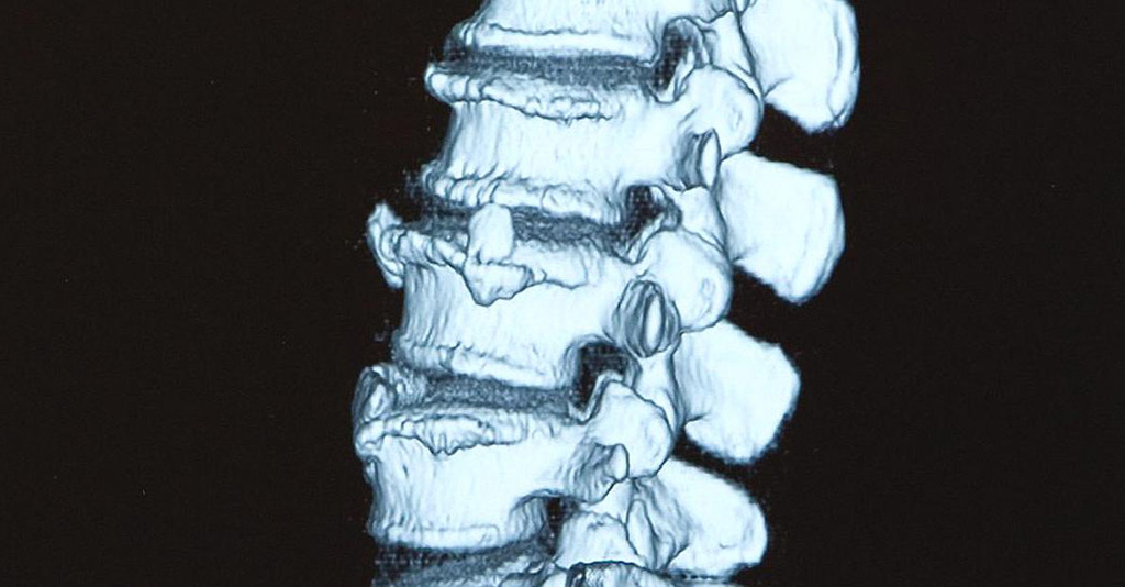 Diagnostic de l'ostéoporose