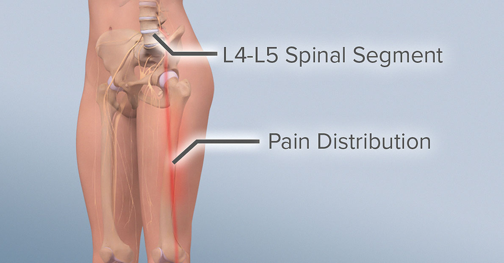 Tout sur le segment spinal L4-L5