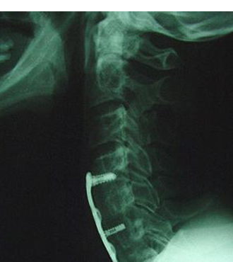 Plaques cervicales : Assurer la stabilité du cou à l'aide d'une instrumentation vertébrale