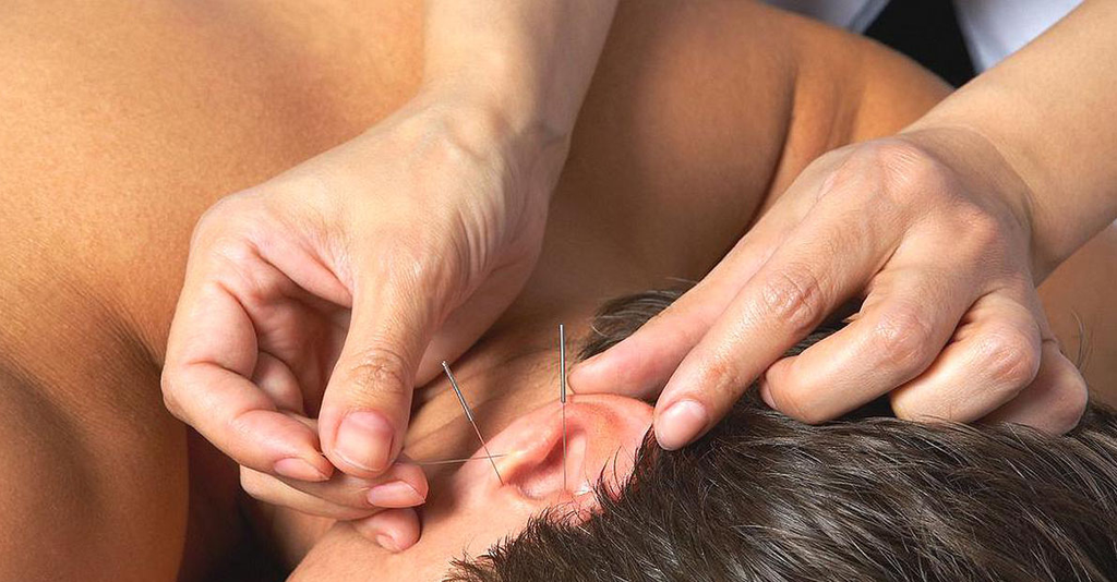 Acupuncture : Un traitement ancien pour un problème actuel
