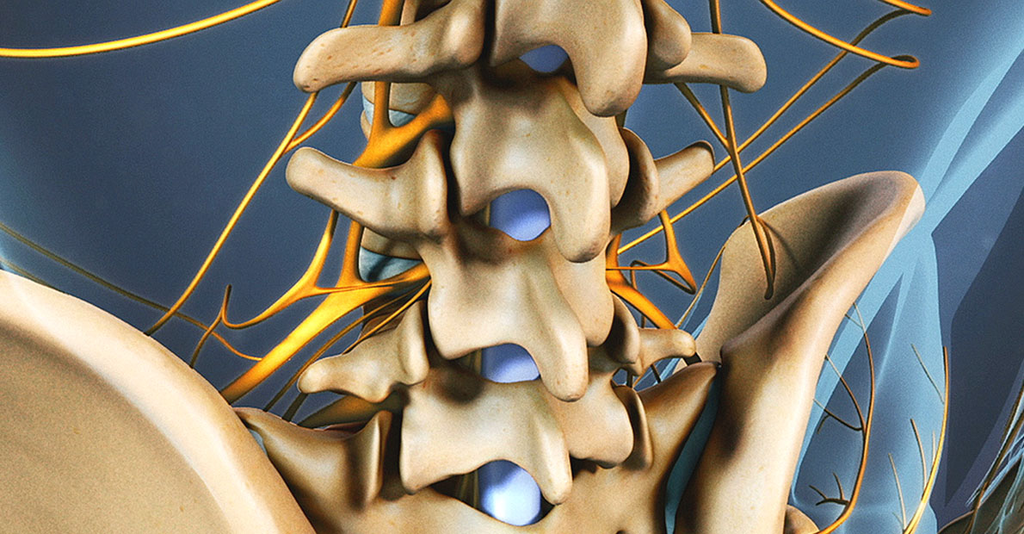 Fusion postéro-latérale ou fusion intersomatique : Les deux principales approches de l'arthrodèse rachidienne
