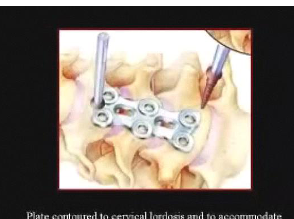 Discectomie et arthrodèse cervicales antérieures avec fixation par plaque cervicale antérieure