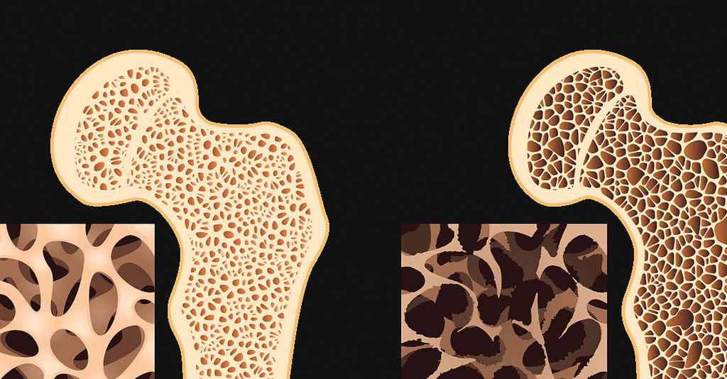 Plan de traitement individualisé de l'ostéoporose