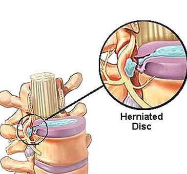 Causes d'une hernie discale