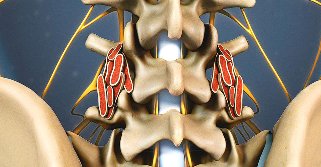 Controverses sur la chirurgie de fusion de la colonne vertébrale : Allogreffes, autogreffes et niveaux d'arthrodèse