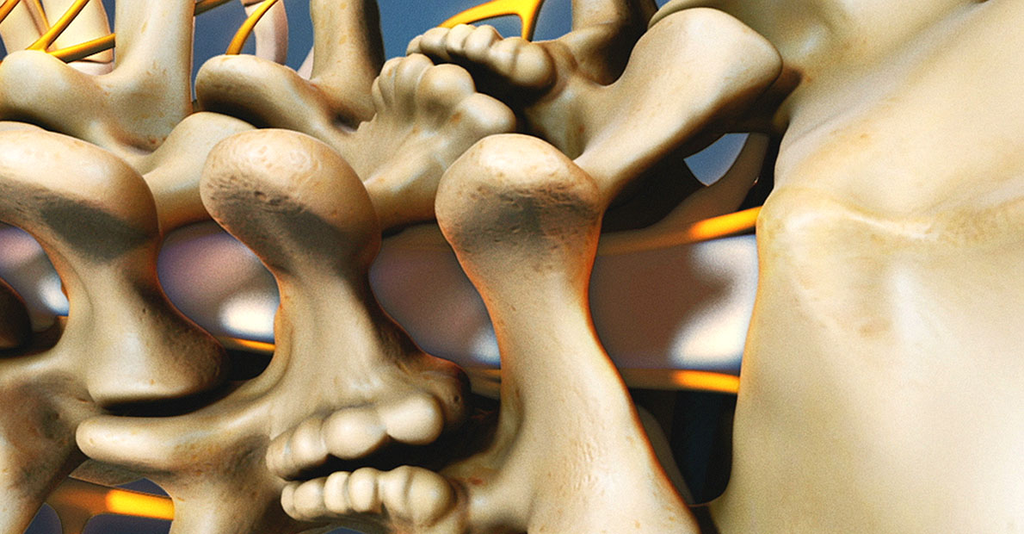 L'arthrodèse rachidienne multi-niveaux